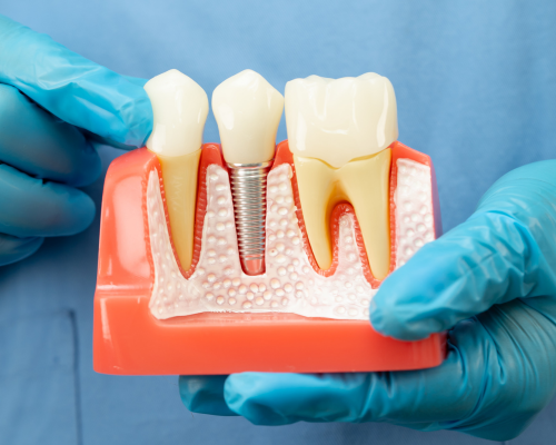 Tooth Cap and Replacement Crown Mysore